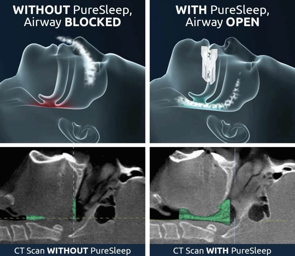 CT scan showing anti snoring device in action 